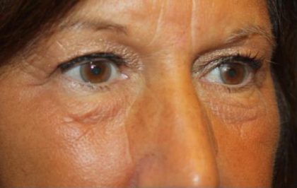 Blepharoplasty Before & After Patient #24858