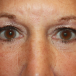 Blepharoplasty Before & After Patient #24858