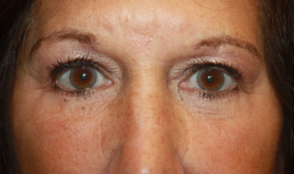 Blepharoplasty Before & After Patient #24858