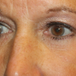 Blepharoplasty Before & After Patient #24858