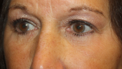 Blepharoplasty Before & After Patient #24858