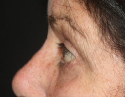 Blepharoplasty Before & After Patient #24902