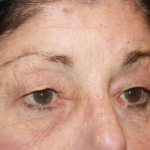 Blepharoplasty Before & After Patient #24902