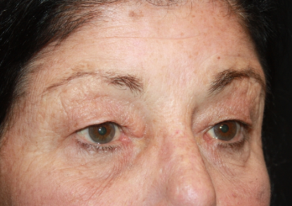 Blepharoplasty Before & After Patient #24902