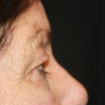 Blepharoplasty Before & After Patient #24902