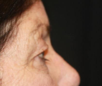 Blepharoplasty Before & After Patient #24902