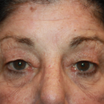 Blepharoplasty Before & After Patient #24902