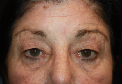 Blepharoplasty Before & After Patient #24902