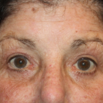 Blepharoplasty Before & After Patient #24902