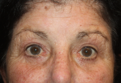 Blepharoplasty Before & After Patient #24902