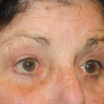 Blepharoplasty Before & After Patient #24902