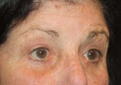 Blepharoplasty Before & After Patient #24902