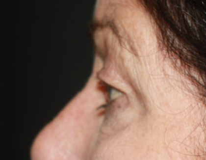 Blepharoplasty Before & After Patient #24902