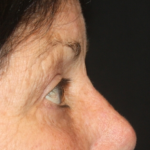 Blepharoplasty Before & After Patient #24902