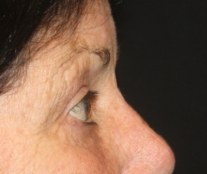 Blepharoplasty Before & After Patient #24902