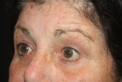 Blepharoplasty Before & After Patient #24902