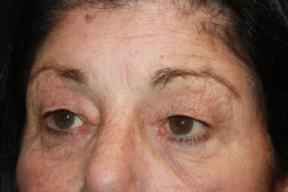 Blepharoplasty Before & After Patient #24902