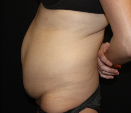 Tummy Tuck Before & After Patient #22345