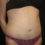 Tummy Tuck Before & After Patient #22345