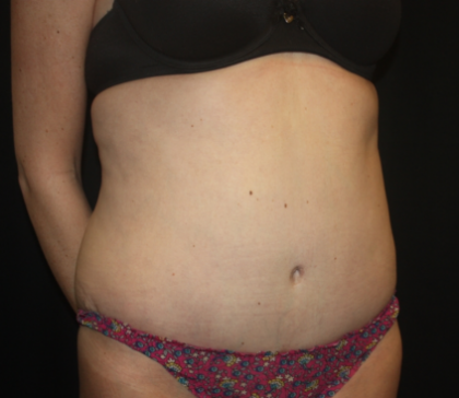 Tummy Tuck Before & After Patient #22345