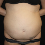 Tummy Tuck Before & After Patient #22345