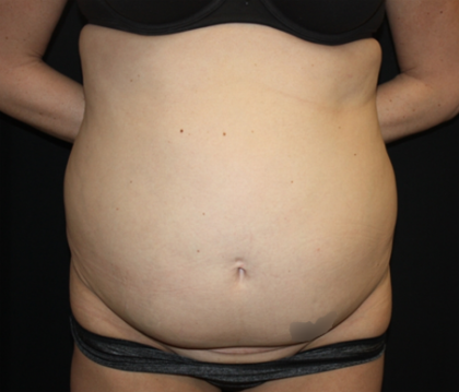 Tummy Tuck Before & After Patient #22345