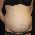 Tummy Tuck Before & After Patient #22345