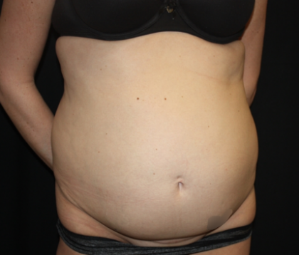 Tummy Tuck Before & After Patient #22345