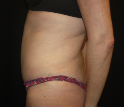 Tummy Tuck Before & After Patient #22345