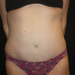 Tummy Tuck Before & After Patient #22345