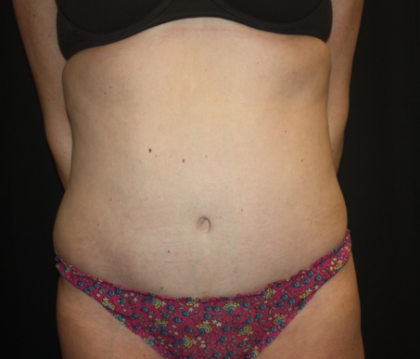 Tummy Tuck Before & After Patient #22345