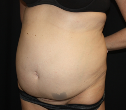 Tummy Tuck Before & After Patient #22345