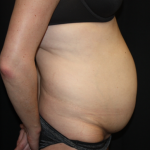 Tummy Tuck Before & After Patient #22345