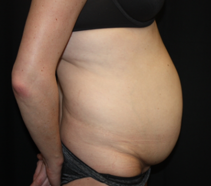 Tummy Tuck Before & After Patient #22345