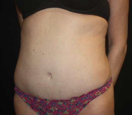 Tummy Tuck Before & After Patient #22345