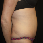 Tummy Tuck Before & After Patient #22345