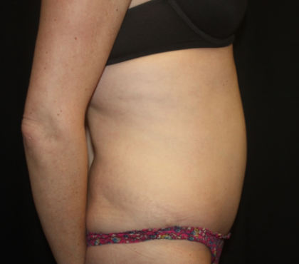 Tummy Tuck Before & After Patient #22345