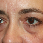 Blepharoplasty Before & After Patient #24881