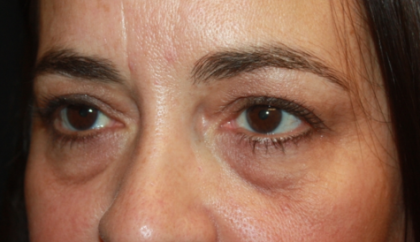 Blepharoplasty Before & After Patient #24881