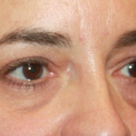 Blepharoplasty Before & After Patient #24881