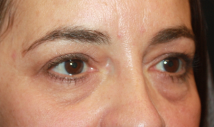 Blepharoplasty Before & After Patient #24881