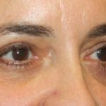 Blepharoplasty Before & After Patient #24881