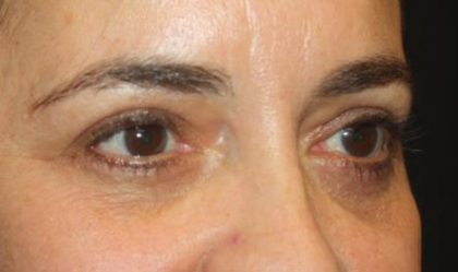 Blepharoplasty Before & After Patient #24881