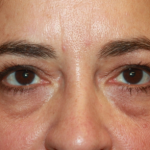 Blepharoplasty Before & After Patient #24881