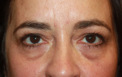 Blepharoplasty Before & After Patient #24881