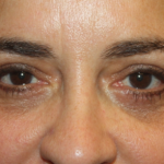 Blepharoplasty Before & After Patient #24881