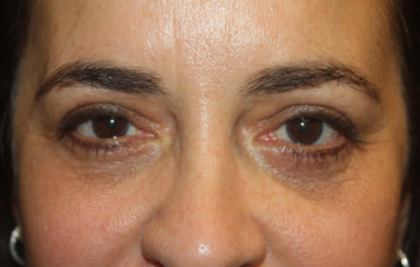 Blepharoplasty Before & After Patient #24881