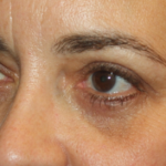 Blepharoplasty Before & After Patient #24881