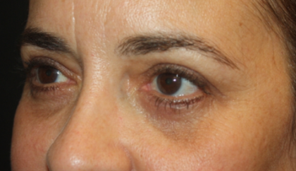 Blepharoplasty Before & After Patient #24881