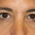 Blepharoplasty Before & After Patient #24882